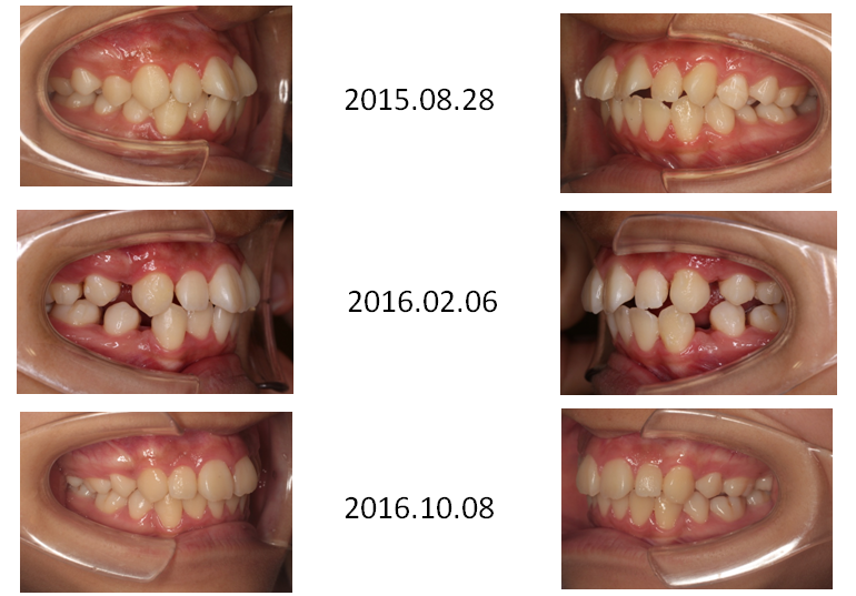 インビザラインで抜歯矯正 インビザライン矯正は東京の銀座クリアデンタルで